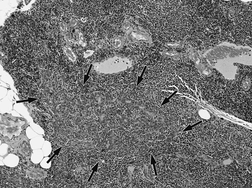 Figure 5 thymus epithelial hyperplasia.bmp