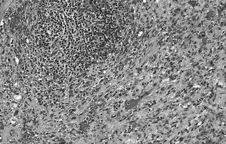 Figure 5 paren fibrosis.bmp