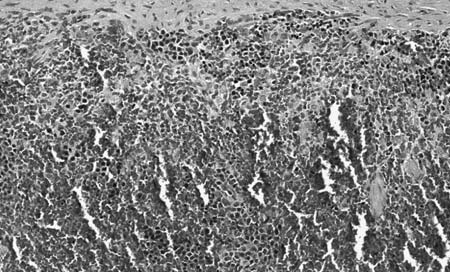 Figure 6 capsule fibrosis.bmp