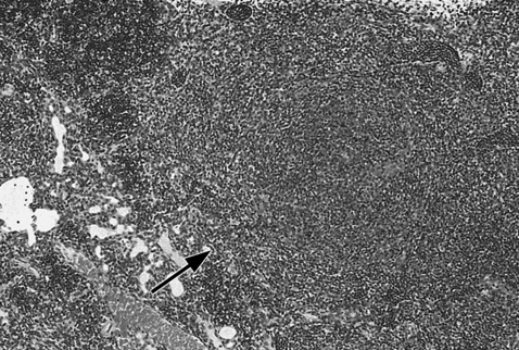 Figure 3 thymus increased lymphocytes.bmp